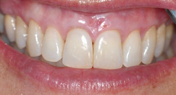 AFTER: A combination of gum grafting and veneers.