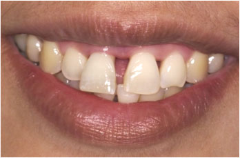 Before picture of a smile of a patient with short loose teeth
