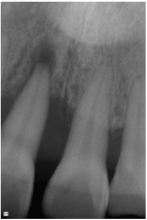 Before x-ray of a patient with short loose teeth