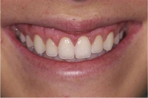 AFTER: Gums are lifted to the normal length of the teeth.