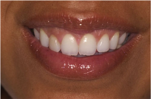 AFTER: The shape of teeth appear more natural after crown lengthening.